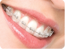 ceramic braces