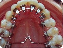 lingual braces