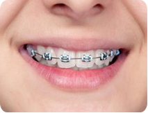 metal braces